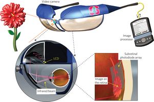 Recuperar la vista gracias a implantes con minipaneles solares en el ojo 28