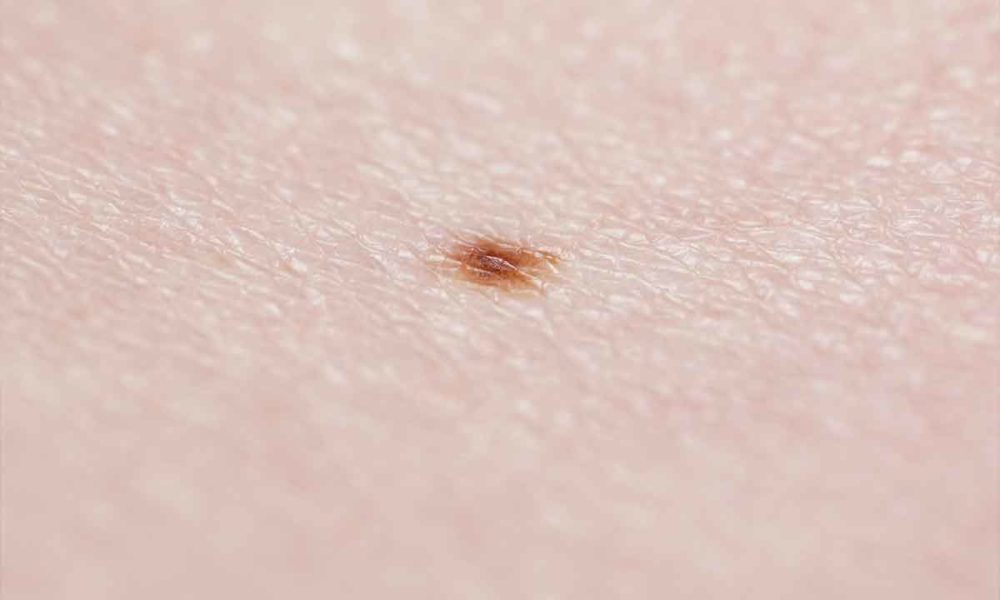 Google quiere ser tu dermatólogo